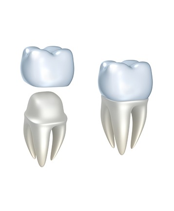 Bow Trail SW Dental Crowns | Nova Dental Care | General & Family Dentist | Bow Trail | SW Calgary