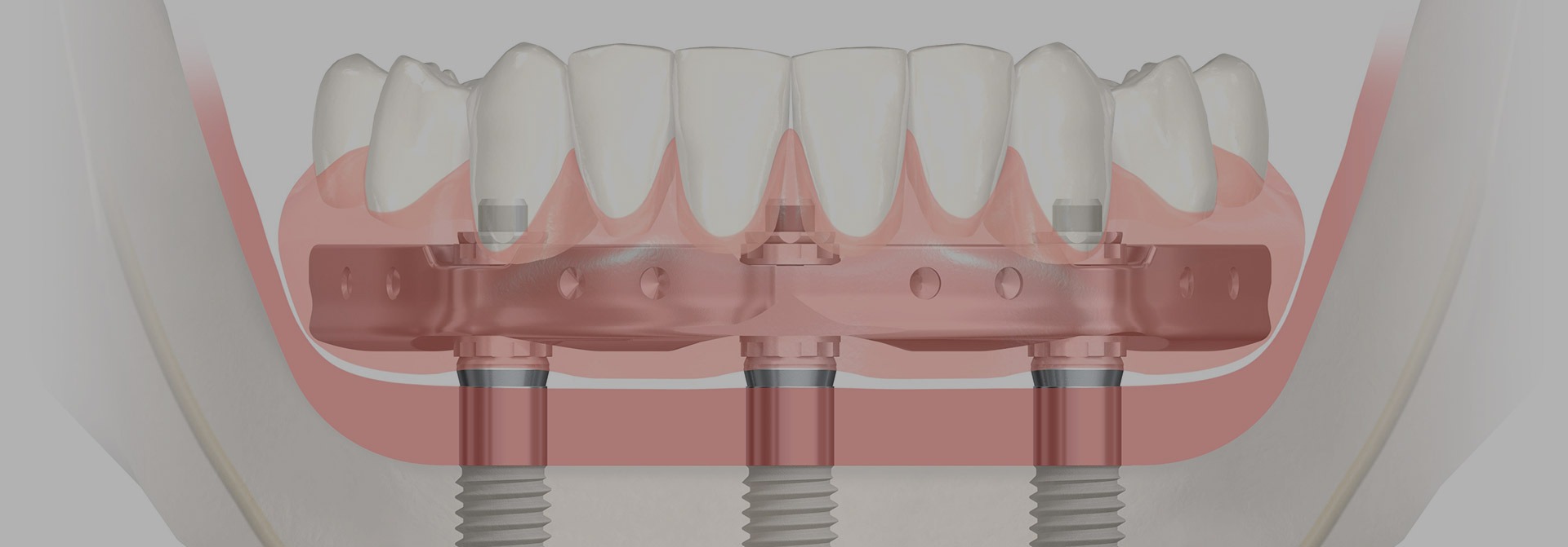 Over Denture Implants | Nova Dental Care | Dentist on Bow Trail